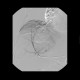 Liver metastases of carcinoid, embolization: AG - Angiography